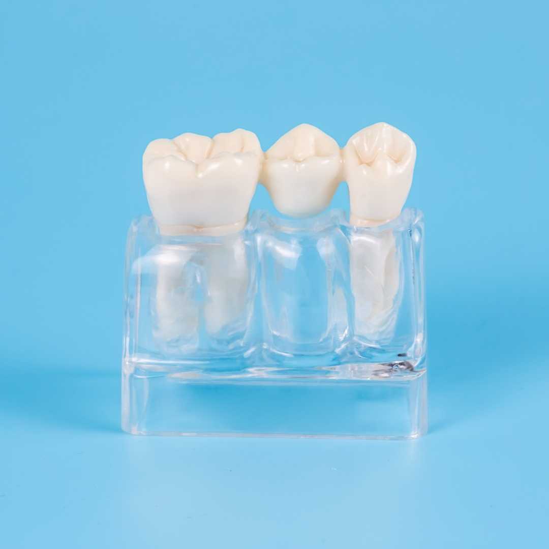 Dental crowns and bridges at Crafting Smiles Dentistry in Richmond Hill